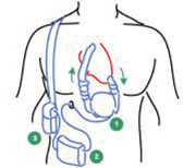 A ventricular assist device A ventricular assist device